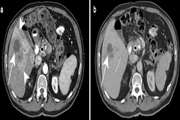 Typical imaging finding of hepatic infections: a pictorial essay